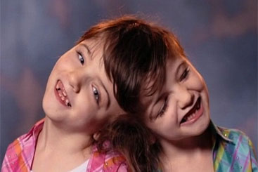 Tatiana e Krista Hogan estão ligadas pelo cérebro e nunca poderão ser separadas. Foto: dailymail.co.uk/Reprodução
