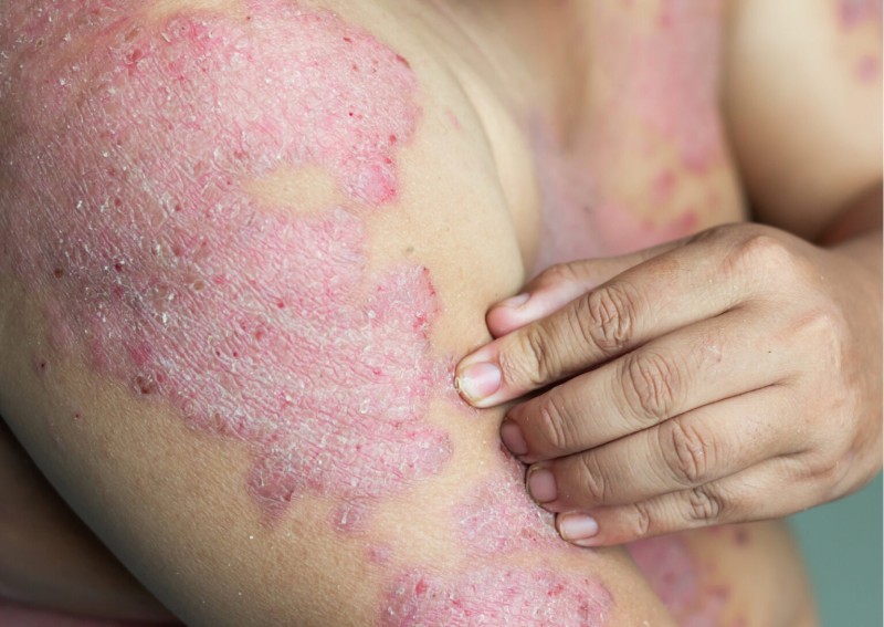 Foto: Divulgação/Psoríase Brasil.Org