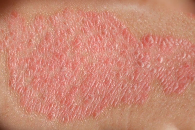 Foto: Sociedade Brasileira de Dermatologia